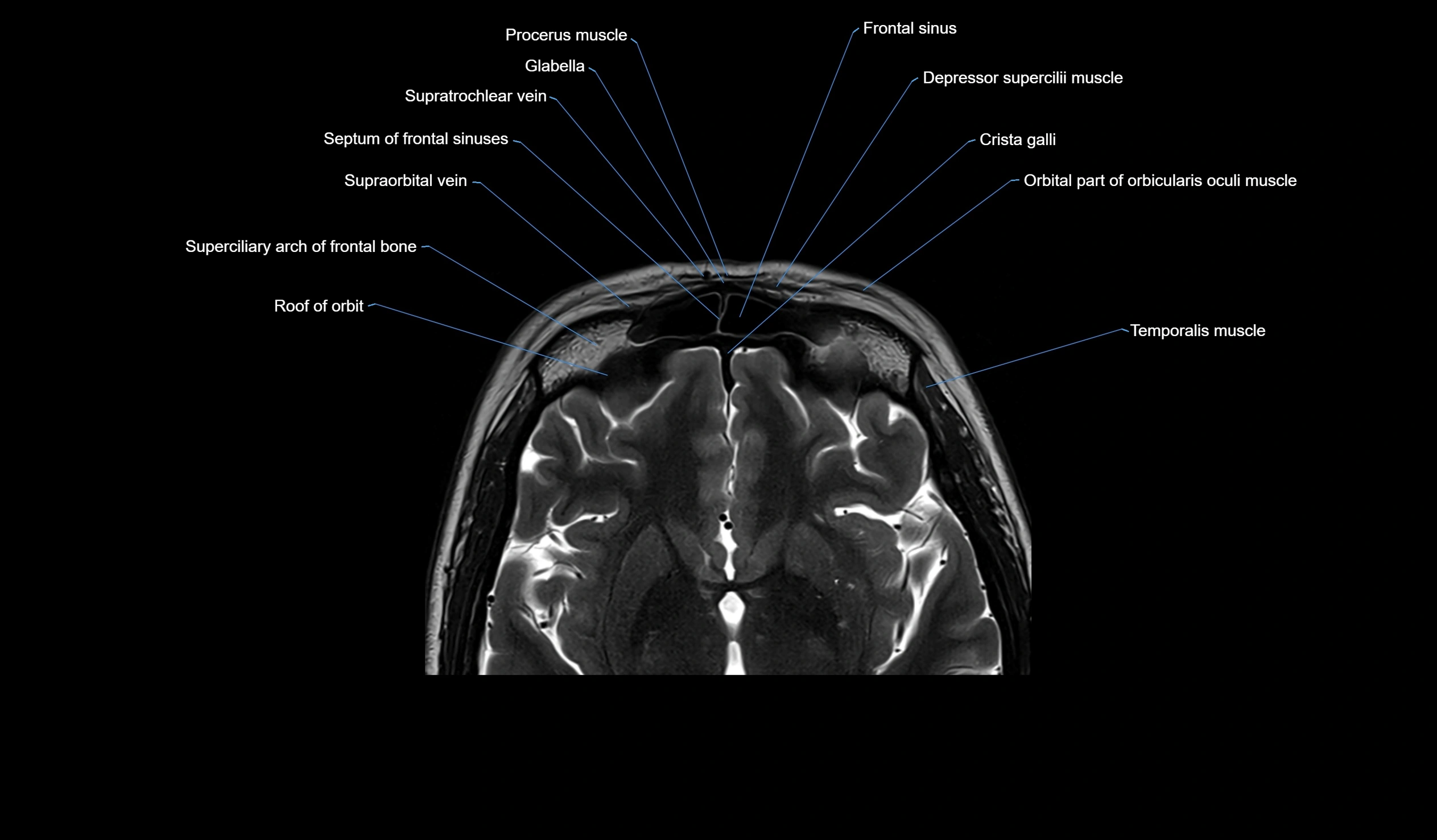 MRI face & paranasal sinuses(PNS) labelled  axial  cross sectional anatomy 3T radiology  image -00028.webp